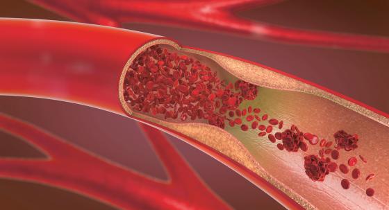 Thrombose